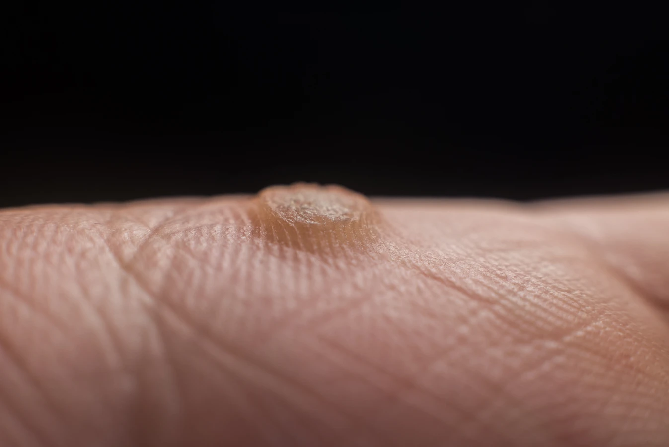 Co na kurzajki dla dzieci?